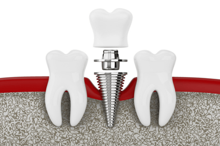Single Tooth Implant